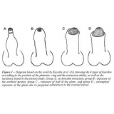 tratamento-urologico-biopsia-peniana-cirurgia-de-postectomia-infantil-onde-encontrar-na-mooca