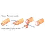 Cirurgia para Fimose Cirurgia para Fimose