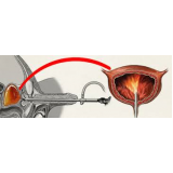 tratamento-urologico-biopsia-peniana-cauterizacao-peniana-em-jose-bonifacio