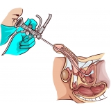 tratamento-urologico-biopsia-peniana-cirurgia-de-postectomia-infantil-onde-encontrar-na-mooca
