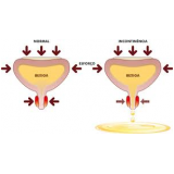 tratamento-urologico-biopsia-peniana-cirurgia-de-postectomia-em-artur-alvim