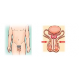 Cirurgia de Vasectomia em São Paulo Cirurgia de Vasectomia em São Paulo