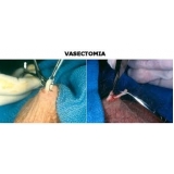 vasectomia-cirurgia-de-vasectomia-em-sao-paulo-cirurgia-de-vasectomia-em-sao-paulo-preco-no-parque-sao-jorge