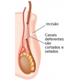 vasectomia-cirurgia-de-vasectomia-em-sao-paulo-cirurgia-de-vasectomia-em-sao-miguel-paulista